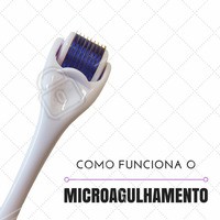 O microagulhamento é um tratamento em que são usadas diversas agulhas de aço cirúrgico, esterilizadas, ao serem aplicadas na pele, provocam pequenas punturas, que aumentam a vasodilatação, estimulam a formação de colágeno, além de aumentar a absorção de alguns produtos usados para melhorar a pele. #Procedimento #Tratamento #Microagulhamento #Cicatrizes #Ahazou #PeleSaudavel #PeleLisa #Autoestima #Colageno #TratamentoFacial #TratamentoCorporal