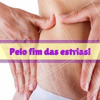 Não existe tratamento que elimine completamente as estrias. Por isso, não saia comprando cremes para estrias antes da avaliação de um profissional. Laser, peeling, cremes com acido retinoico, e radiofrequência fracionada podem ajudar a diminuir. #estrias #ahazou #esteticacorporal #tratamentocorporal #beleza #bemestar #autoestima