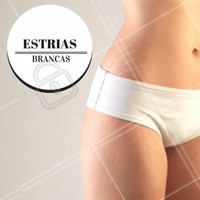 As estrias brancas apresentam esta cor devido à falta de produção de melanina naquele local específico, o que indica que a capacidade de regeneração da pele neste ponto é muito pequena, por isso, para elimina-las o ideal é a utilização de métodos mais aprimorados como o peeling químico, à base de ácidos, ou o laser de CO2, por exemplo. Estes tratamentos estimulam a circulação sanguínea local, favorecendo a formação de novas células de colágeno e de elastina.
#ahazou #estética #beauty