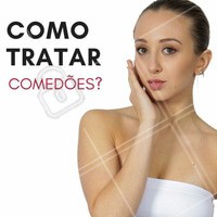 Evite a automedicação e espremer os comedões! É muito útil a limpeza de pele, com esteticista experiente, o uso de esfoliantes (sabonetes, cremes, loções), peeling de diamante ou cristal, peelings químicos superficiais, à base de ácido retinoico, ácido glicólico, salicílico e alguns medicamentos de uso local, como ácido retinoico, adapaleno, peróxido de benzoíla, e outros. #ahazou #estetica #comedões #saúde #bemestar