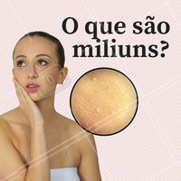Os miliuns são pequenos cistos que aparecem na pele como lesões amareladas ou brancas, e contém acumulo de queratina em seu interior. #milium #cisto #pele