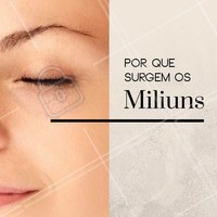 Os miliuns surgem espontaneamente e podem acontecer em qualquer tipo de pele, sendo mais comum no rosto, mas podendo aparecer em qualquer lugar do corpo. #milium #cisto #pele