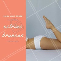 As estrias brancas são dessa cor por conta da falta de produção de melanina na área específica, isso quer dizer que a capacidade de regeneração da pele no local é muito pequena. Neste caso, para eliminá-las o ideal é a utilização de métodos mais aprimorados como o peeling químico a base de ácidos, ou o laser de CO2, por exemplo. Estes tratamentos estimulam a circulação sanguínea local, favorecendo a formação de novas células de colágeno e de elastina. #estrias #estéticacorporal #beleza #tratamentos