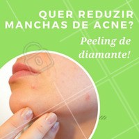 Se você sofre com manchas e cicatrizes de acne, agende já o seu horário para uma consulta e descubra o poder do peeling de diamante! 💎 #peelingdediamante #esteticafacial #esteticacomamor #ahazou #peeling