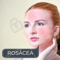 A rosácea é uma doença de pele comum, cujos sintomas envolvem áreas de vermelhidão na pele e lesões inflamadas, especialmente nas bochechas, nariz, testa e queixo.
É possível tratar e diminuir esse problema, venha fazer uma avaliação com quem entende do assunto. #esteticafacial #rosacea #ahazou #beleza #tratamentofacial #autoestima #pelesaudavel