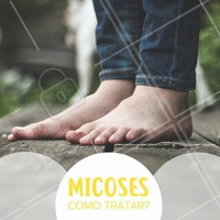 A micose de unha é uma doença muito comum e que as pessoas em geral dão pouca atenção, porém, se tratada corretamente desde o início, a micose pode ser curada sem maiores problemas.
O objetivo do tratamento é substituir a unha doente por uma saudável. As unhas dos pés podem levar cerca de 12 meses para se renovar totalmente e o tratamento deve ser mantido durante todo este tempo, de forma tópica. Também é possível fazer fototerapia para os pés, com aplicação de laser para ampliar a efetividade da medicação que combate o fungo causador da micose.
#podologia #ahazou #micose #cuidadoscomospés #fototerapia #tratamento