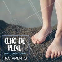 A verruga plantar, mais conhecida como "olho de peixe" é causada por uma infecção viral, no caso o vírus é o HPV. Se a verruga estiver crescendo ou dolorida, é importante procurar um profissional para avaliar o quadro. Os tratamentos médicos envolvem o uso de ácido salicílico, de vacinas, de crioterapia (congelamento) e tratamento a laser.
#podologia #ahazou #olhodepeixe #tratamento #cuidadoscomospés