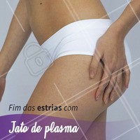 Acabe com as estrias que tanto te incomodam com o jato de plasma! Que tal agendar uma avaliação? #esteticacorporal #ahazou #estrias #jatodeplasma