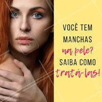 Para amenizar e controlar o aparecimento de manchas, é necessário tomar alguns cuidados:
1. Usar diariamente o filtro solar mesmo em dias nublados;
2. É possível usar despigmentantes como o ácido kójico e hidroquinona para clarear as manchas;
3. Passar por sessões de peeling também é importante para inibir a produção excessiva de pigmento e de clarear as camadas mais superficiais através da descamação e afinamento da pele.
#manchas #peeling #esteticafacial #ahazouestetica#cuidadoscomapele #peleperfeita