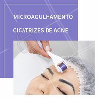 Muitas pessoas sofrem com as cicatrizes deixadas pela acne na juventude ou até pela acne adulta. Mas você sabia que o microagulhamento é capaz de amenizar essas cicatrizes e trazer resultados incríveis para sua pele? Agende já sua avaliação! #microagulhamento #ahazou #estetica #esteticafacial #acne #cicatrizes #manchas