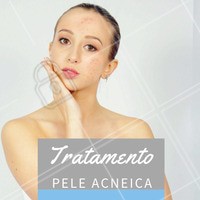 A pele acneica é muito frequente nos brasileiros, que têm a pele mais oleosa por conta das condições climáticas. A pele oelosa também é mais comum entre os jovens, mas também existe a acne adulta. Praticamente todos os casos de acne podem ser controlados ou até curados. Tratar a acne é importante para evitar marcas e cicatrizes no rosto e em outras regiões do corpo. O importante é começar o tratamento o mais rápido possível! #acne #ahazou #esteticafacial #estetica
