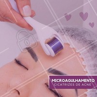 Muitas pessoas sofrem com as cicatrizes deixadas pela acne na juventude ou até pela acne adulta. Mas você sabia que o microagulhamento é capaz de amenizar essas cicatrizes e trazer resultados incríveis para sua pele? Agende já sua avaliação! #microagulhamento #ahazou #estetica #esteticafacial #acne #cicatrizes #manchas
