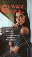 A acne pode surgir de diversos fatores. Por isso é tão importante o cuidado de um profissional qualificado, para avaliar a causa da acne e encontrar o melhor processo de cura. #acne #ahazou #esteticafacial #estetica