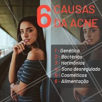 A acne pode surgir de diversos fatores. Por isso é tão importante o cuidado de um profissional qualificado, para avaliar a causa da acne e encontrar o melhor processo de cura. #acne #ahazou #esteticafacial #estetica