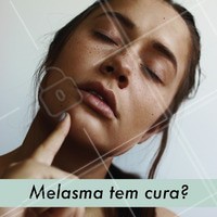 O Melasma é uma doença de pele que não tem cura, porém tem controle. Existem muitos tratamentos para o melasma, como peelings específicos e tratamentos com laser, além de clareadores que podem ser usados em casa. O indispensável é sempre o uso constante do protetor solar! #melasma #ahazou #esteticafacial