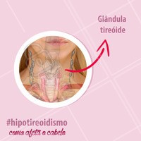 O que é #hipotireoidismo e como isso afeta nossos cabelos?
Uma produção insuficiente desses hormônios é conhecida como HIPOTIREOIDISMO assim como a produção excessiva como HIPERTIREOIDISMO.
Esses distúrbios da tireóide são mais frequentes em mulheres do que em homens, numa proporção de 5 para 1.
-
No hipotireoidismo, o paciente descreve a queda de cabelo crônica e difusa, a queratina fica mais frágil e a aparência do cabelo é geralmente mais áspera e seca. Em suma, temos um cabelo mais pobre e desbotado.
-
É conveniente melhorar a alimentação, para nutri-lo internamente, assim como evitar os focos de estresse, pois podem piorar a condição.
#vocesabia #tiroide #ahazou #hipotiroidismo #hipertiroidismo #cabelos