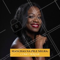 Os tratamentos personalizados para as machas da pele negra são uma opção segura e eficaz para amenizar as manchinhas de acne ou axilas escuras por exemplo.
🔹 Entre os procedimento mais indicados, podemos citar a laserterapia, peelings e dermocosméticos específicos.
🔹 O laser fracionado não ablativo, é ideal para o tratamento de manchas e o Laser ND yag pode ser usado no tratamento de olheiras.
É necessário estar atento à todas as especificidades no tratamento estético da pele negra, para que não sejam deixadas cicatrizes ou que não ocorra clareamento excessivo. #esteticafacial #ahazou #pelenegra #manchas