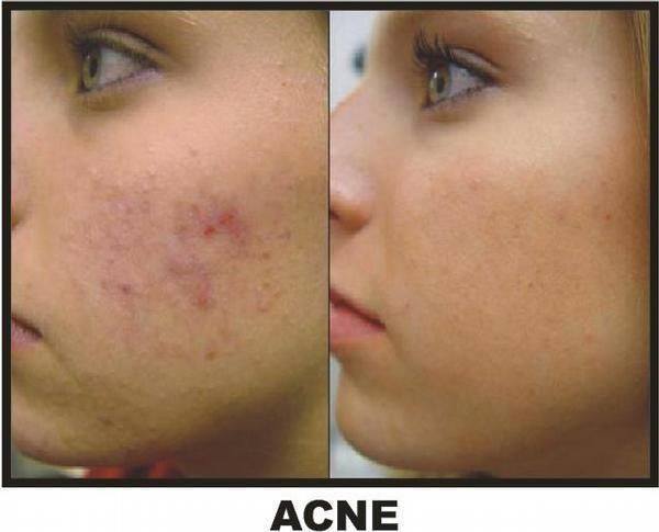tratamento acne estética  esteticista