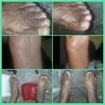 Antes e Depois Esses são os pés de um cliente atendido por mim em home care.