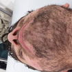 Depilação barba (antes) 