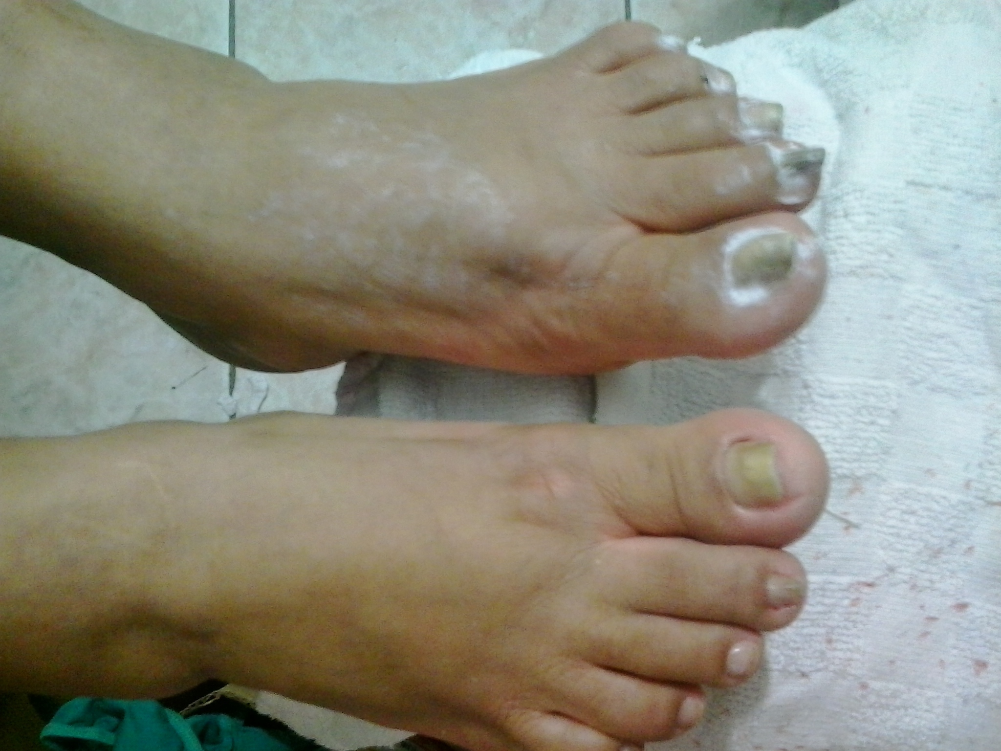 Unha encravada e micose Esta unha eu ameeei fazer a cliente ficou super satisfeita!  manicure e pedicure