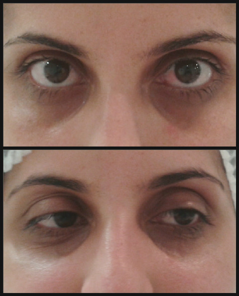 Tratamento para área dos olhos , para redução de bolsas e clareamento . designer de sobrancelhas esteticista maquiador(a)