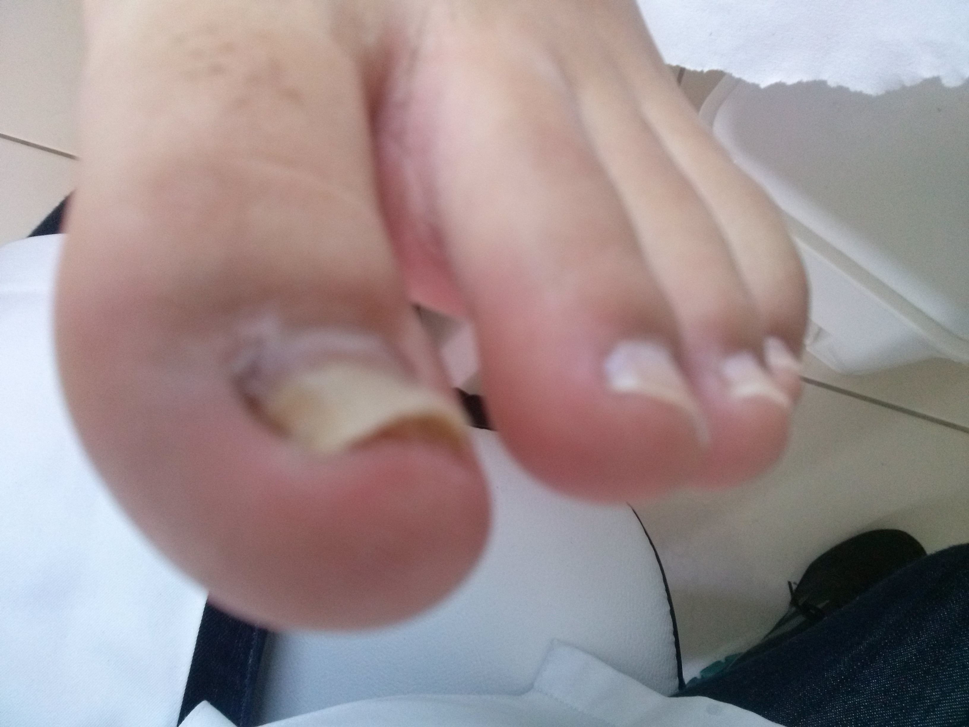 Onicomicose no Hálux..antes do Laser Terapia podólogo(a)