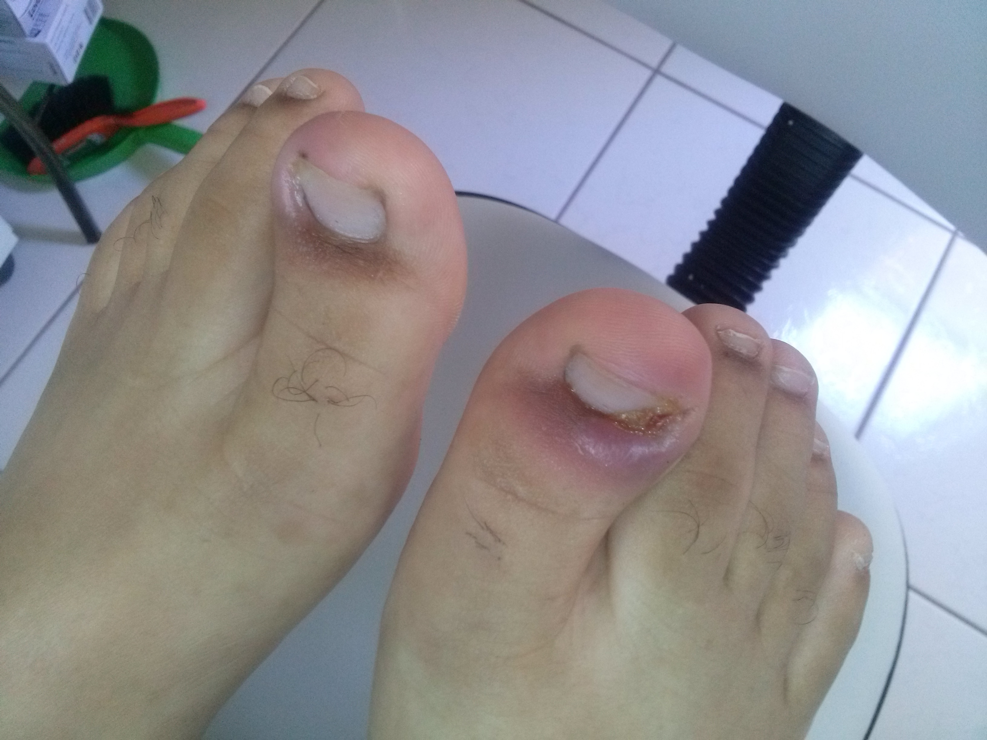 Granuloma bilaterais do hálux podólogo(a)