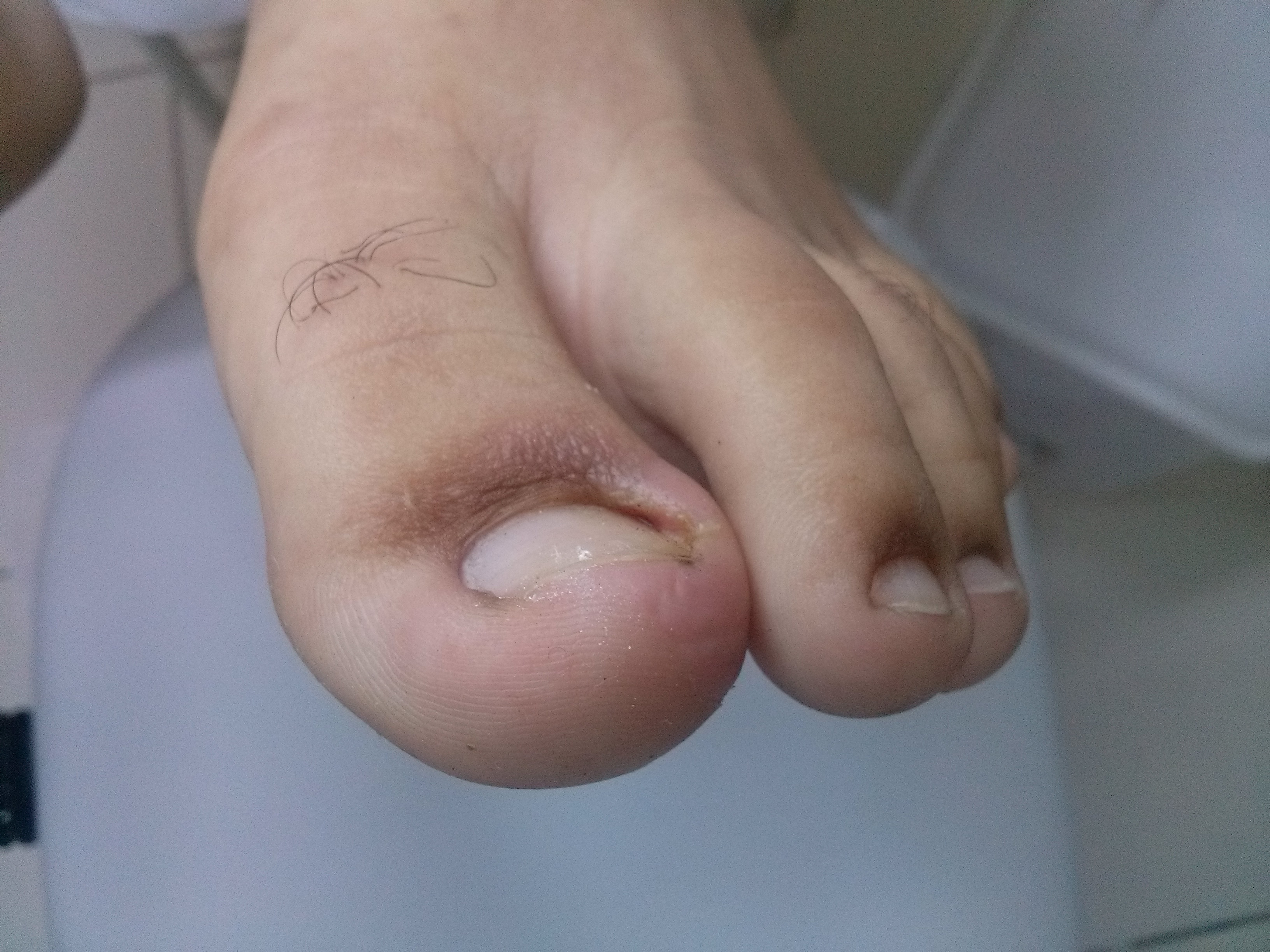 Retorno depois de 2 dias que foi realizado a espiculactomia. podólogo(a)