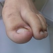 Retorno depois de 2 dias que foi realizado a espiculactomia.