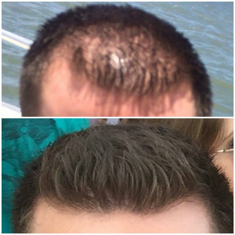 Antes e depois do tratamento de alopecia  esteticista