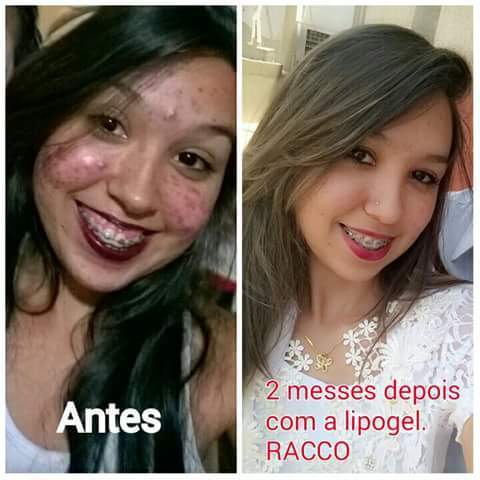 #tratamento com a linha lipogel da racco,para peles acneicas e oleosas.resultado garantido. massoterapeuta esteticista consultor(a)