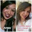 #tratamento com a linha lipogel da racco,para peles acneicas e oleosas.resultado garantido.