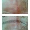 Antes e depois! Treininho básico em pele de porco, para provar que é possível fazer fios em quem não tem nada de pelo. #micropigmentaçao #microfioafio #diseignerdesobrancelhas

