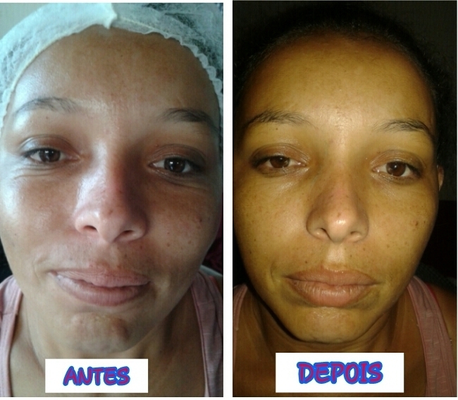 #HIDROPLASTIA FACIAL,COM PRODUTOS RACCO massoterapeuta esteticista consultor(a)