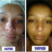 #HIDROPLASTIA FACIAL,COM PRODUTOS RACCO