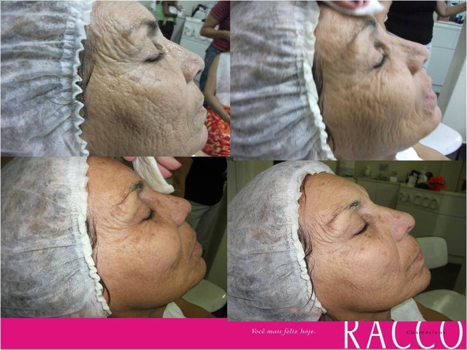 #Marmorizaçao Facial,Racco!! massoterapeuta esteticista consultor(a)