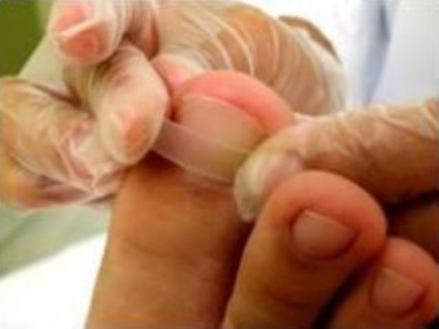 tratamento podologico com fmm para unha encravada podólogo(a) manicure e pedicure