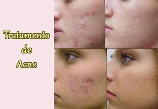 Tratamento de acne esteticista depilador(a)