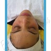 Drenagem linfática facial feita como demonstração para tratamento de olheiras, pálpebras mais escuras, vascularização intensa. Lado direito efetuada as manobras e lado esquerdo para demonstração do antes.
Cliente em tratamento, relata melhora de quadro de insônia e relaxamento profundo.
#drenagemfacial
#drenagemesaude
3esteticacomresultados