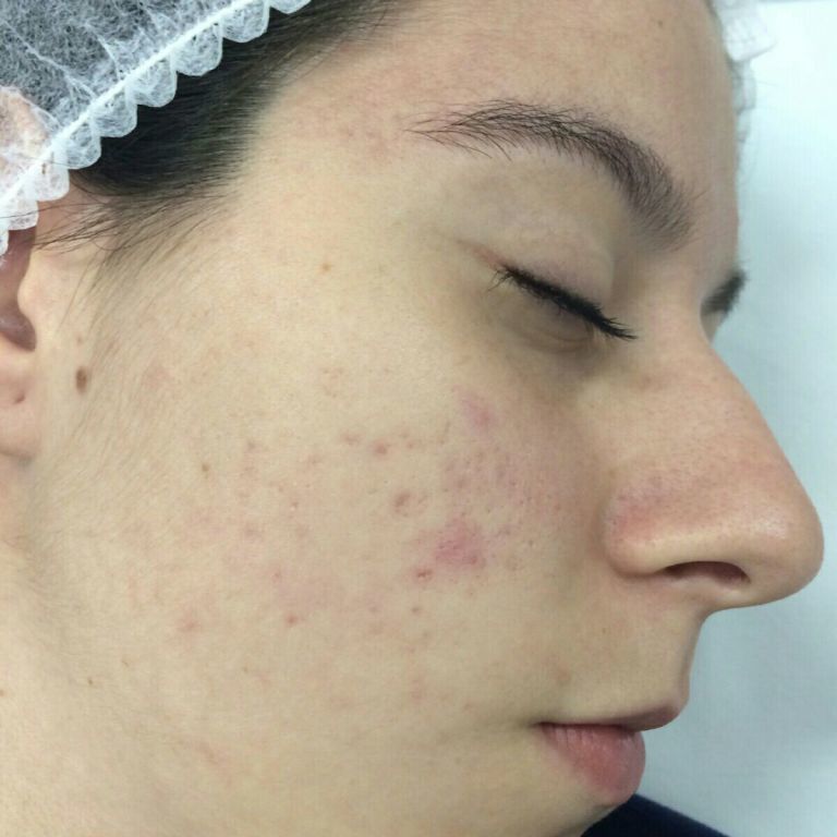 Tratamento de acne estética estudante (esteticista) auxiliar administrativo