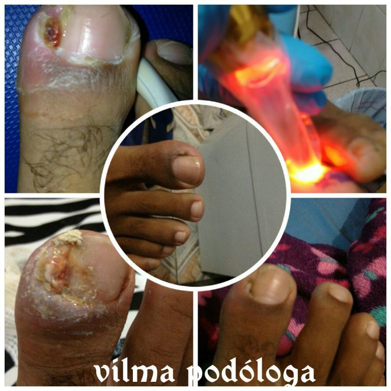 tratamento para onicocriptose (unha encravada) outros podólogo(a) cabeleireiro(a) fisioterapeuta outros