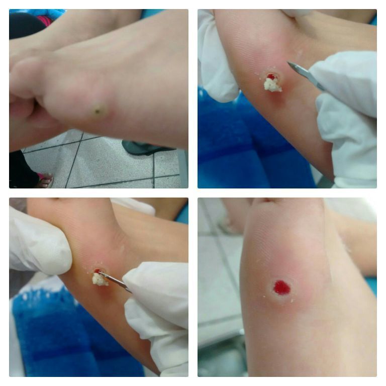 Retirada bicho de pé outros podólogo(a) cabeleireiro(a) fisioterapeuta outros