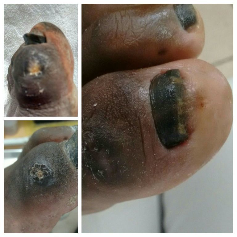Tratamento em.diabéticos úlcera de pressão outros podólogo(a) cabeleireiro(a) fisioterapeuta outros