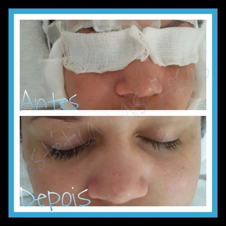 #limpezadepele
#esteticalaisrosas
#amoestetica
 esteticista