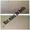 Tratamento para estrias ,