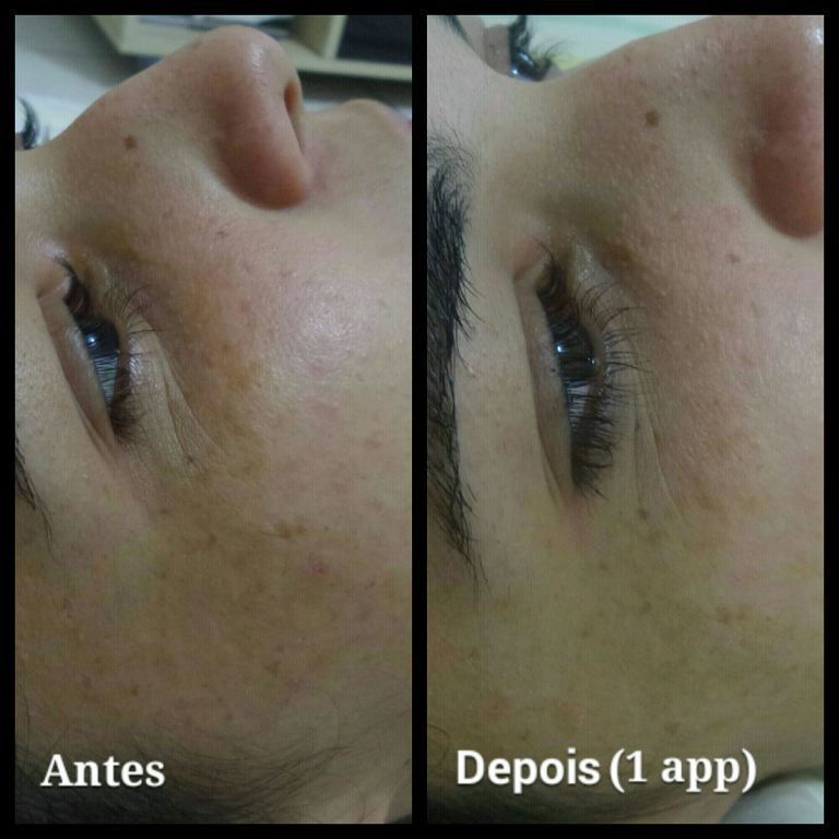 Para quem sofre de melasma a melhor opção é tratamentos a base de ácidos. estética esteticista esteticista designer de sobrancelhas depilador(a)