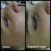 Para quem sofre de melasma a melhor opção é tratamentos a base de ácidos.