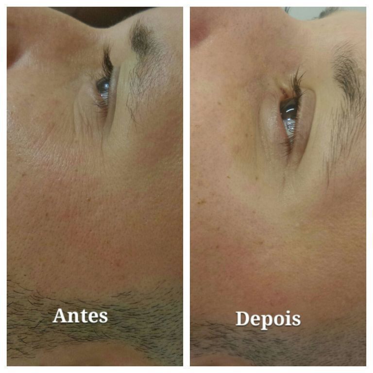 Tratamento de Rejuvenescimento!!  Com apenas  5 sessões! estética esteticista esteticista designer de sobrancelhas depilador(a)