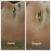 Tratamento de Rejuvenescimento!!  Com apenas  5 sessões!